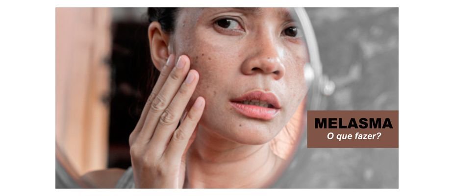 Melasma: O que fazer quando as manchas aparecem?
