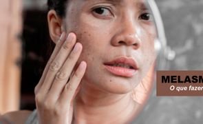 blog extreme uv melasma