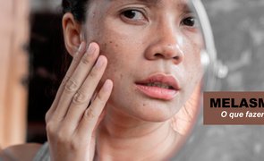 blog extreme uv melasma