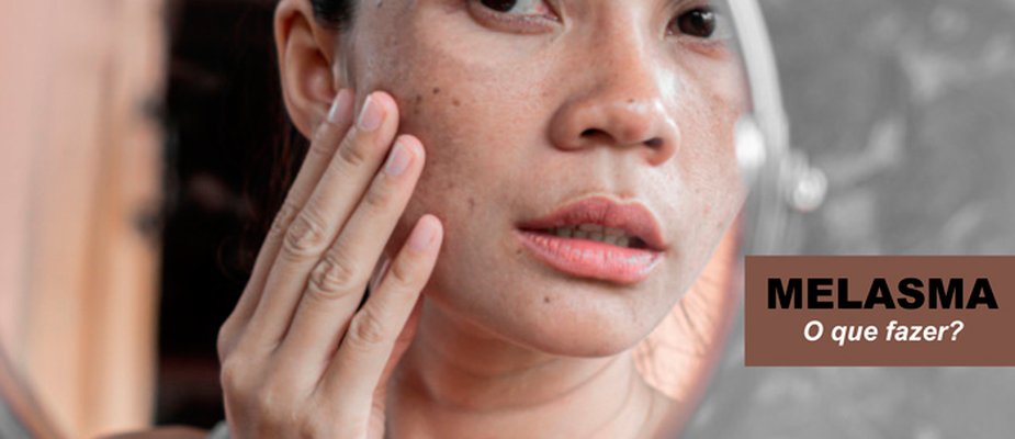Melasma: O que fazer quando as manchas aparecem?